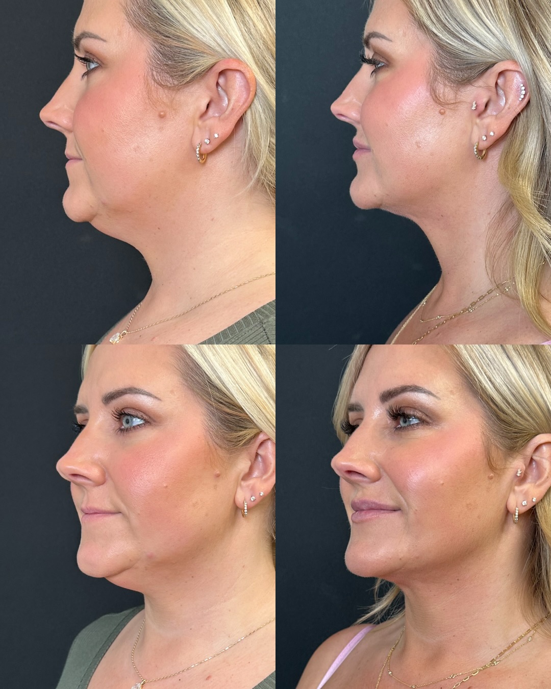 Dr. Fredman at Amelia Facebook ad: A defined jawline and neck contour can make…