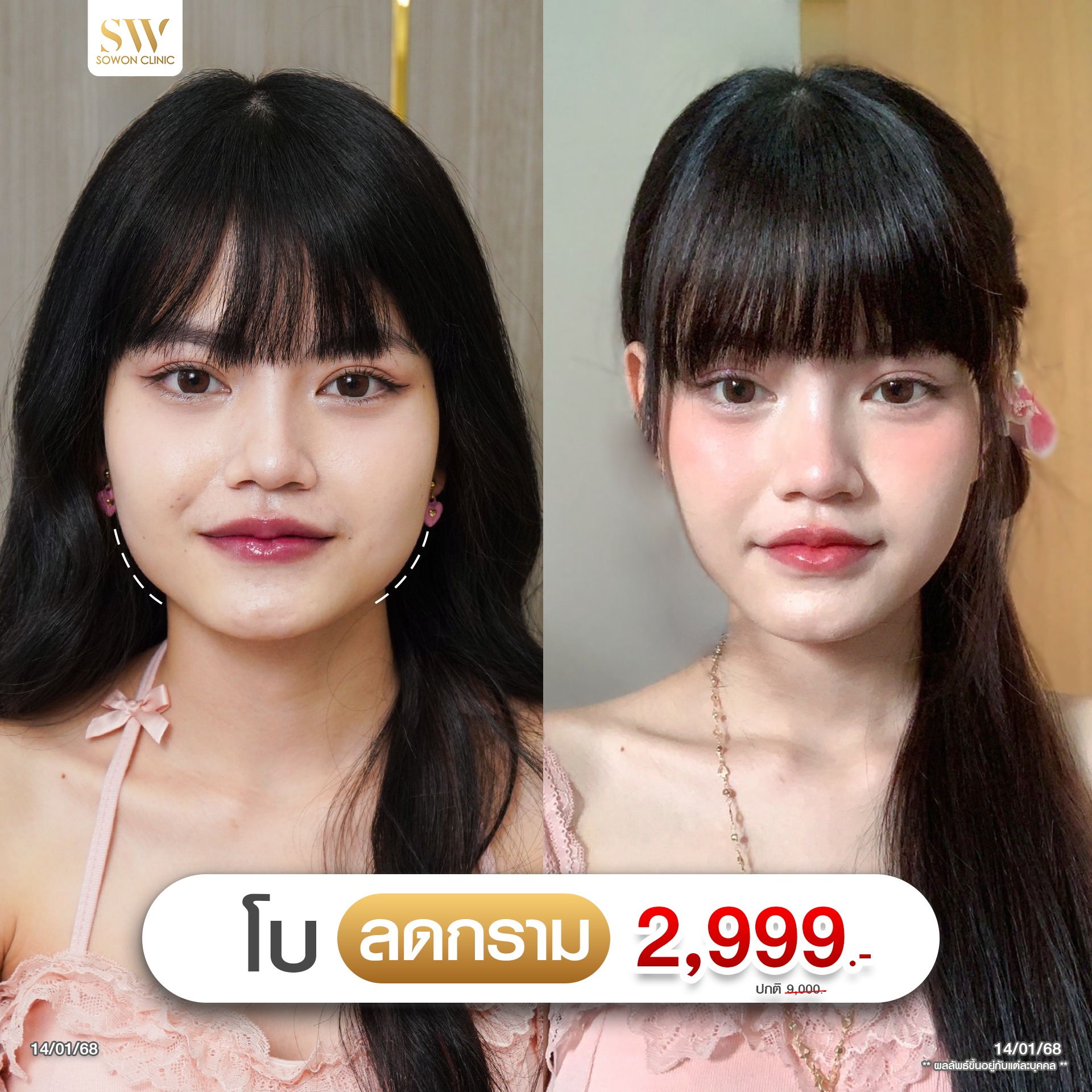 Sowon clinic Botox Filler HIFU ร้อยไหม โบท็อกซ์ ฟิลเลอร์ ปรับรูปหน้า Facebook ad