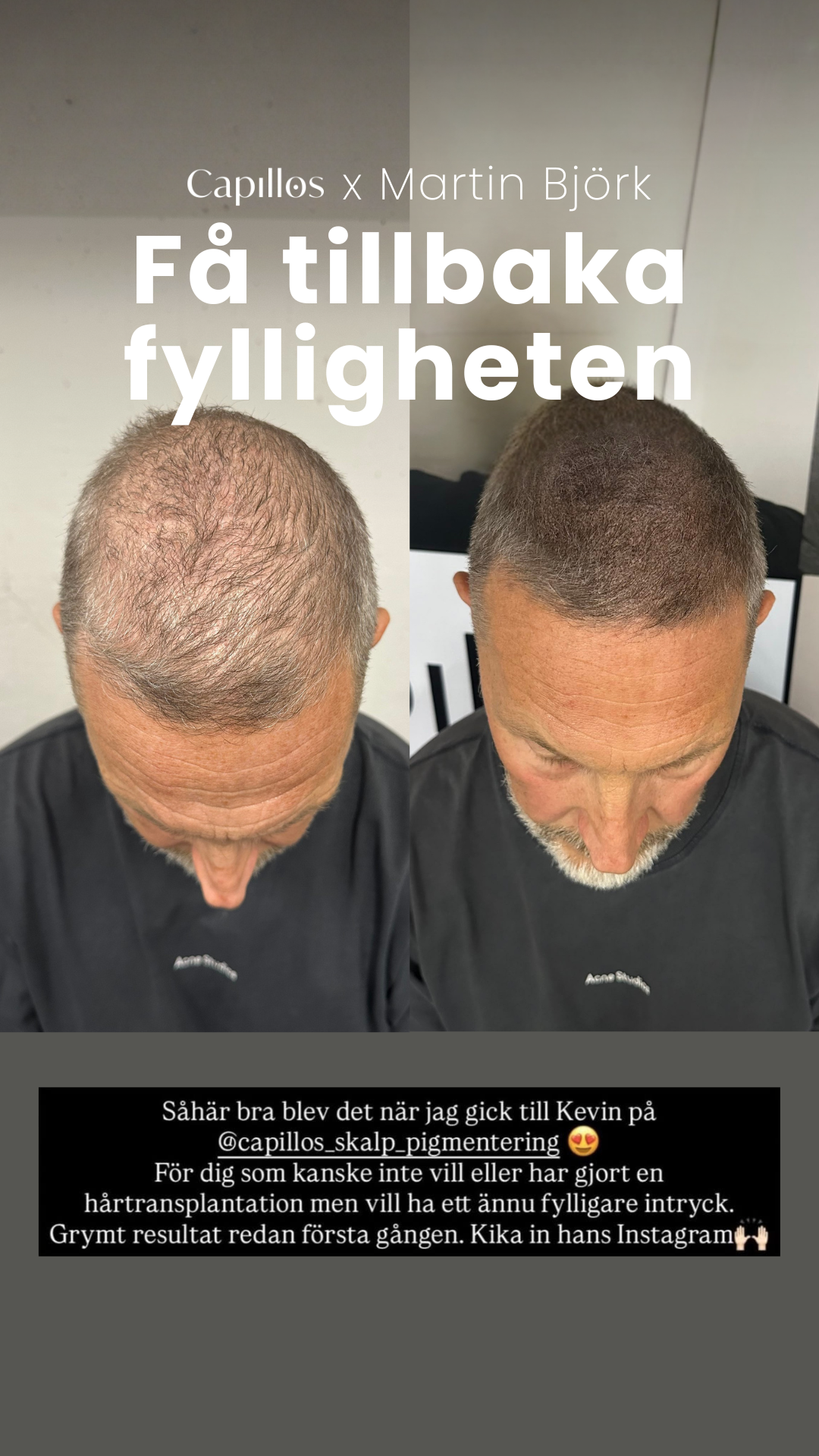Scalp Micropigmentation Capillos Facebook ad from Feb 24, 2026