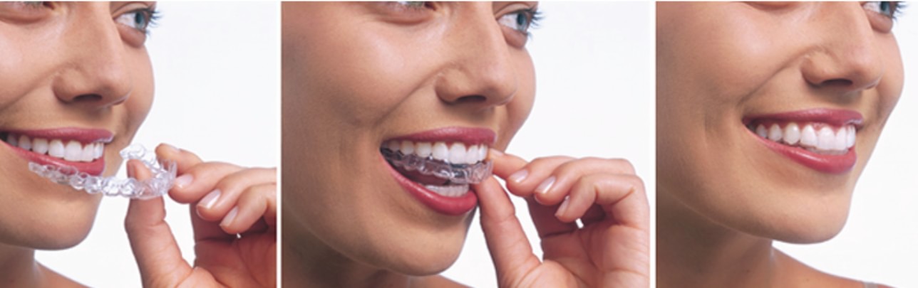 Bracesandsmiles- Kandivali Facebook ad: BRACESANDSMILES- kandivali is a part of bracesandsmiles.in …
