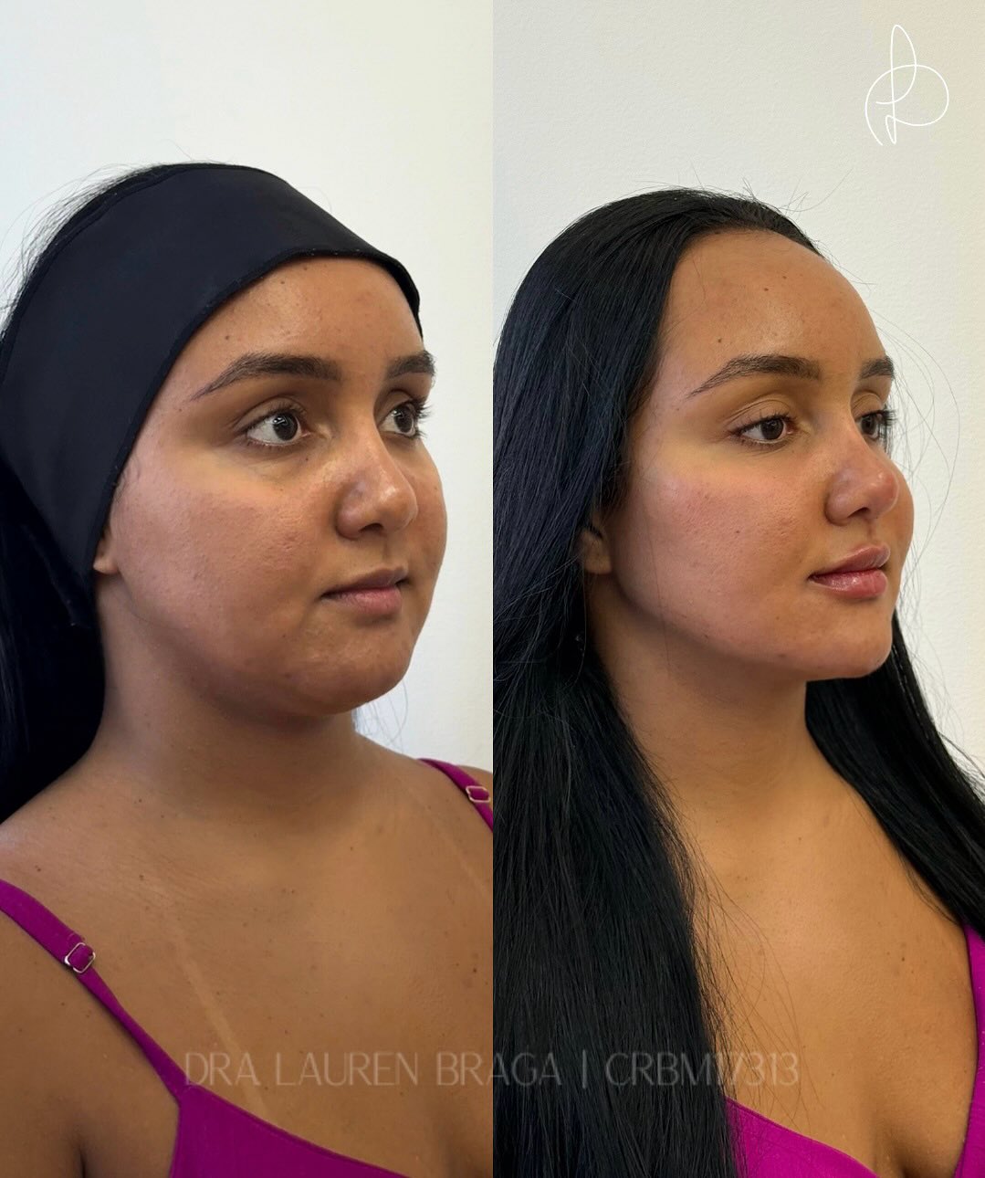 laurenbraga Facebook ad: Um rosto mais arredondado, olheiras profundas e um…