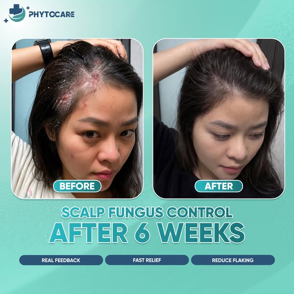 Fungus Scalp - Dermatology Clinic Cebu Facebook ad: It’s NOT Just Dandruff, It Could Be Scalp Fungus