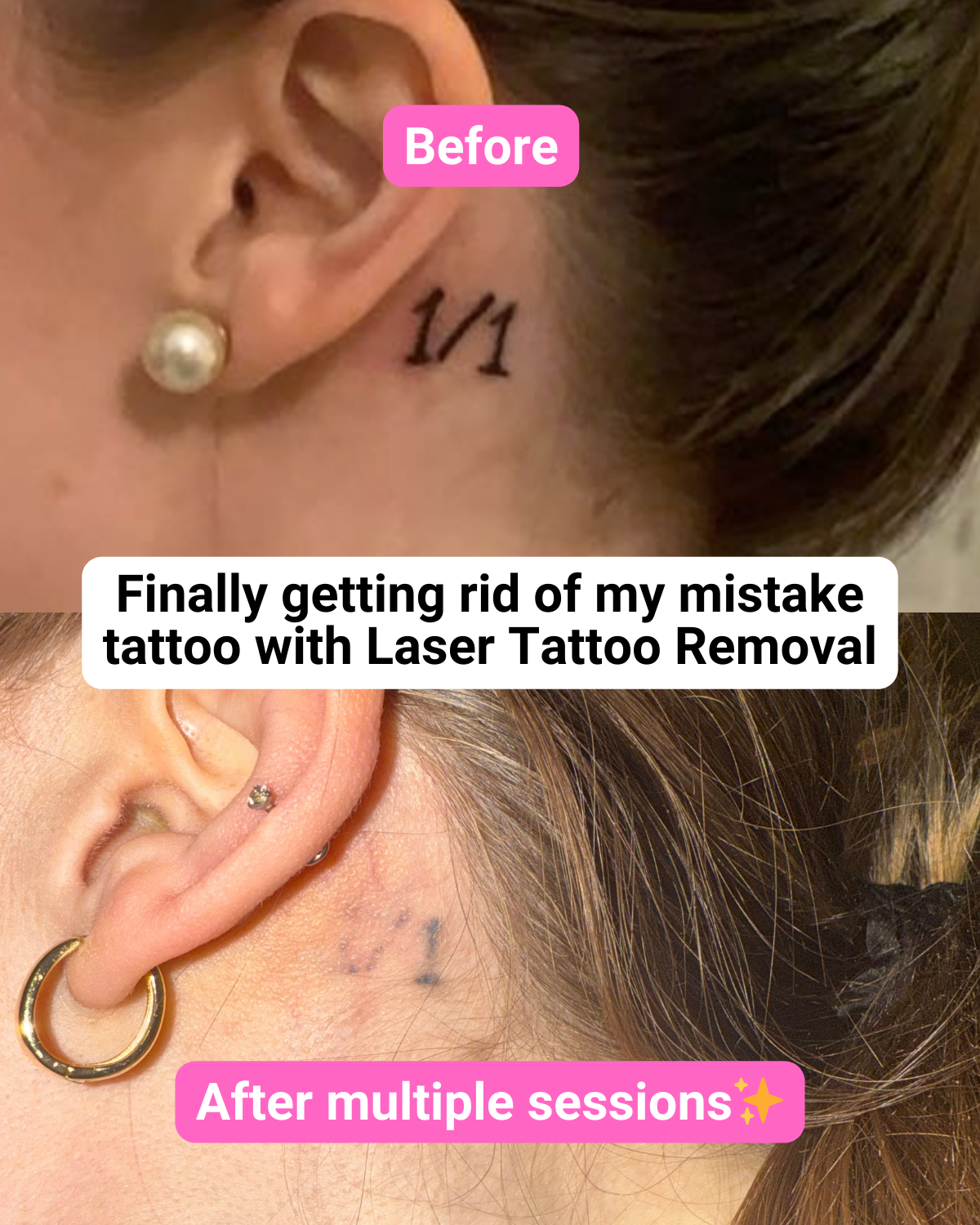 LaserAway Facebook ad