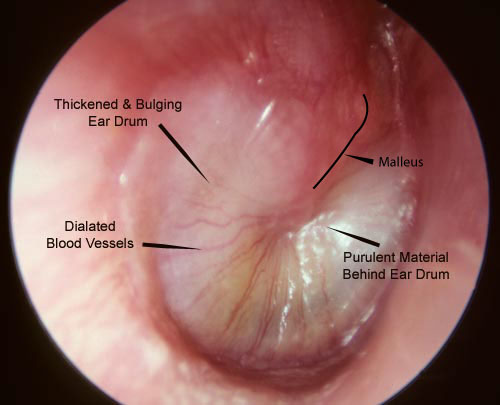ApproXie Urgent Care Athens Facebook ad: Ear Infections After a Cold?