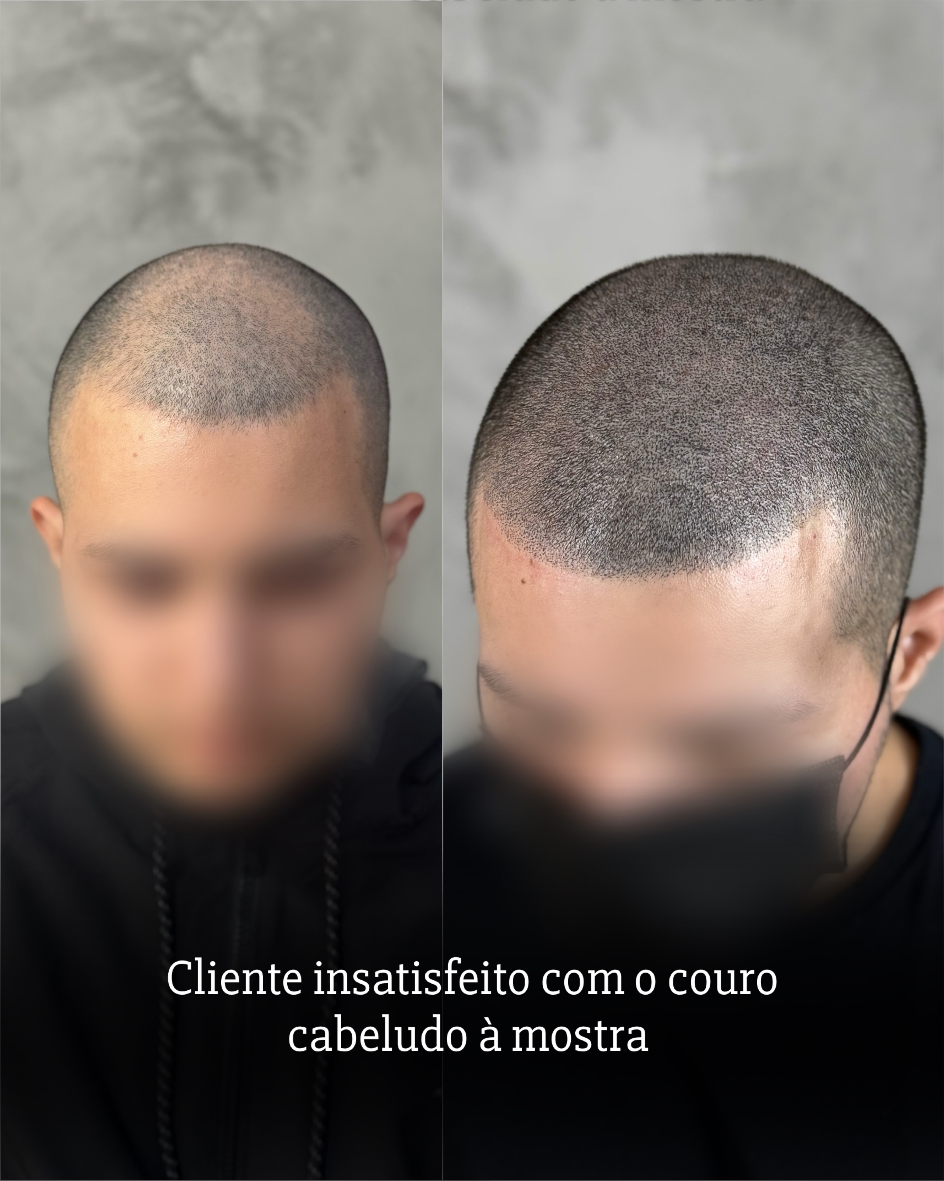 Geisa Silva - Micropigmentação Capilar Facebook ad: É o fim da calvície!