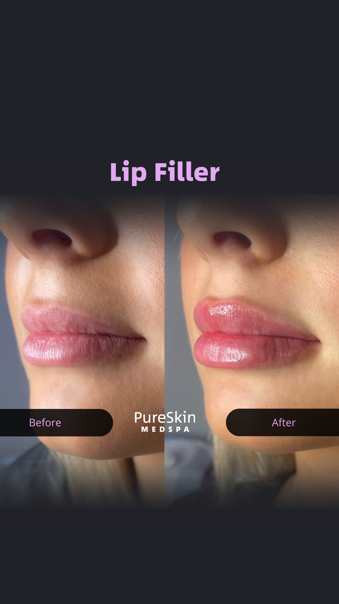 Pure Skin Facebook ad: CT MedSpa | Subtle Volume, Big Confidence