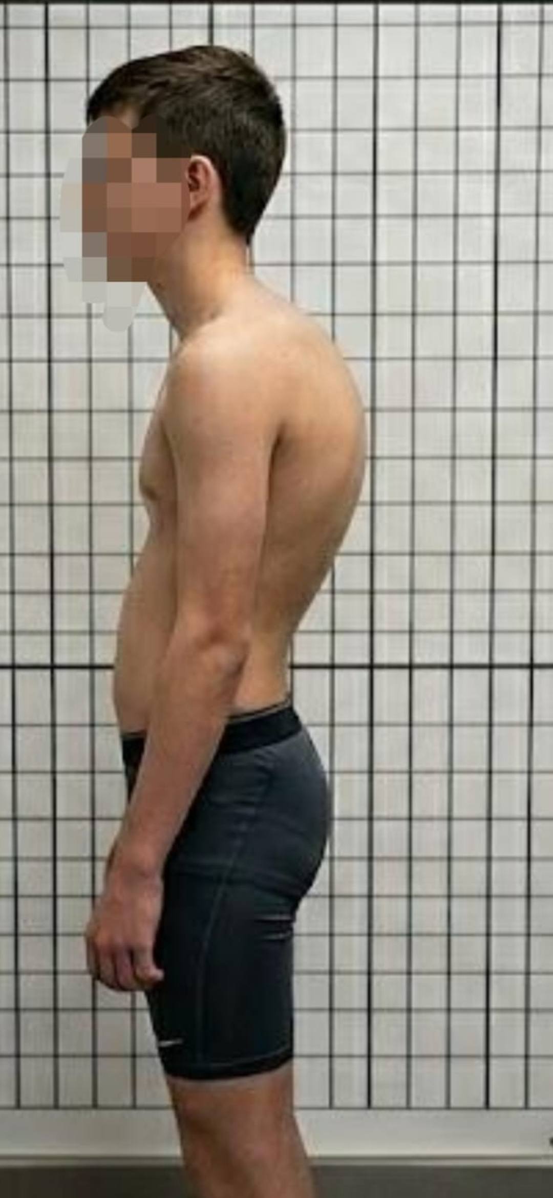Scoliosis Conservative Care & Schroth Physiotherapy New Zealand Facebook ad: Ever noticed that teenage slouch?