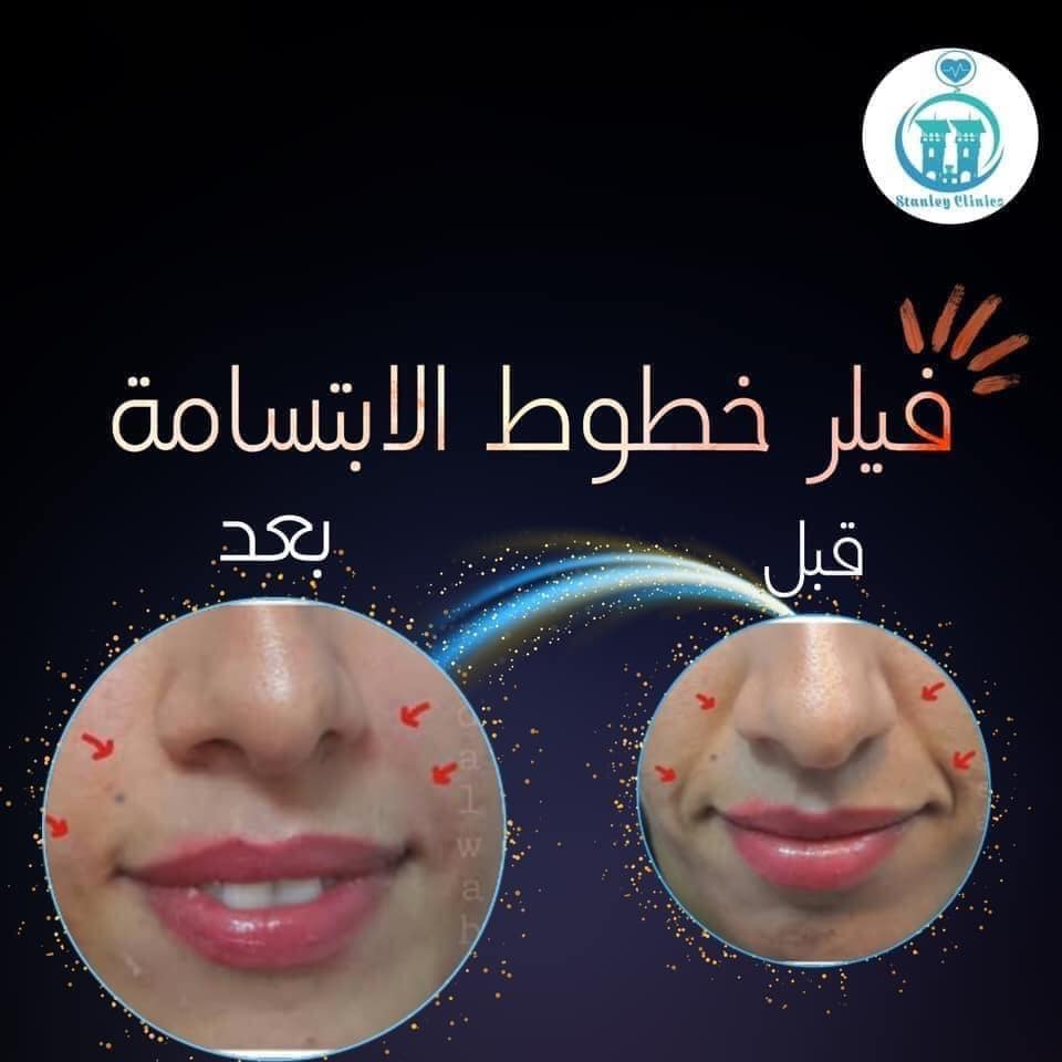 Stanley Care Clinics عيادة ستانلي Facebook ad: يمكن علاج خطوط الابتسامة بالفيلر ويكون من خلال…