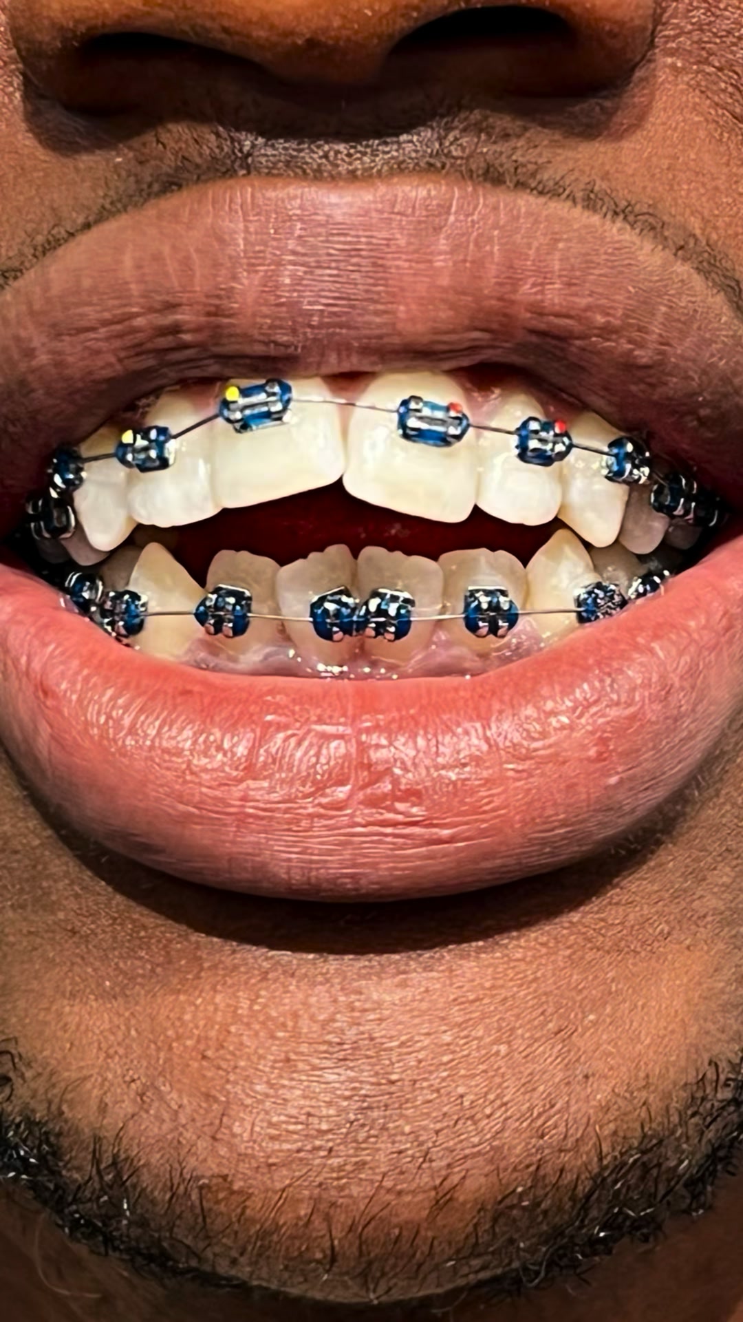 Zoom Exclusive Dental Care PHC Facebook ad: Book Your Dental Veneers Appointment