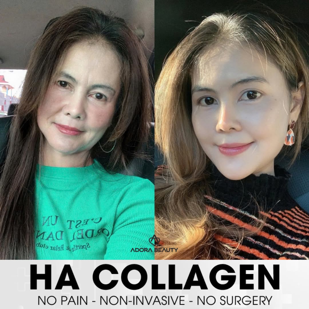 ADORA International Aesthetic Institute - Manila Branch Facebook ad