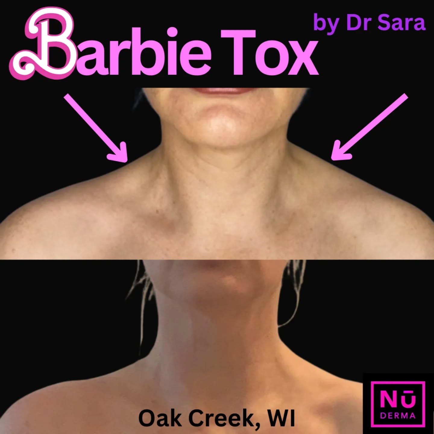 NuDerma Medspa and Wellness Center Facebook ad: Slim your NECK with Dr Sara