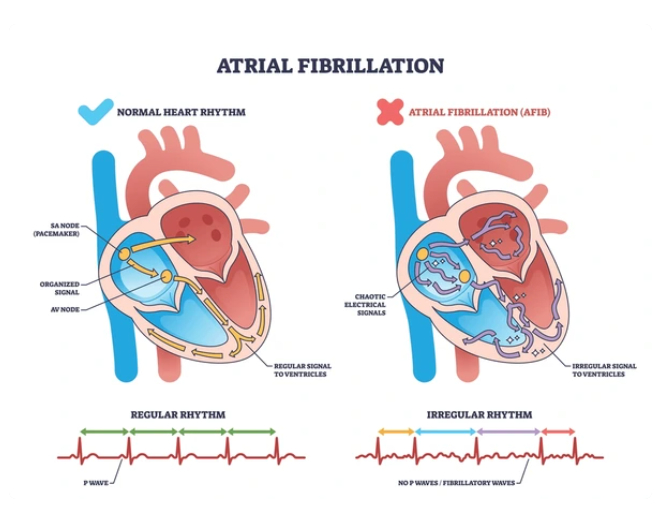 Yeta Wellness Facebook ad: Non-Valvular AFib Treatment: 2-Minute Quiz