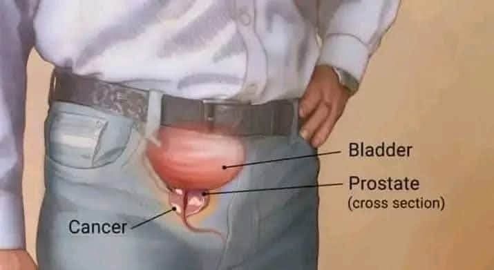 Naturopathic vs Allopathic Medicine Facebook ad: Enlarged Prostate Gland.