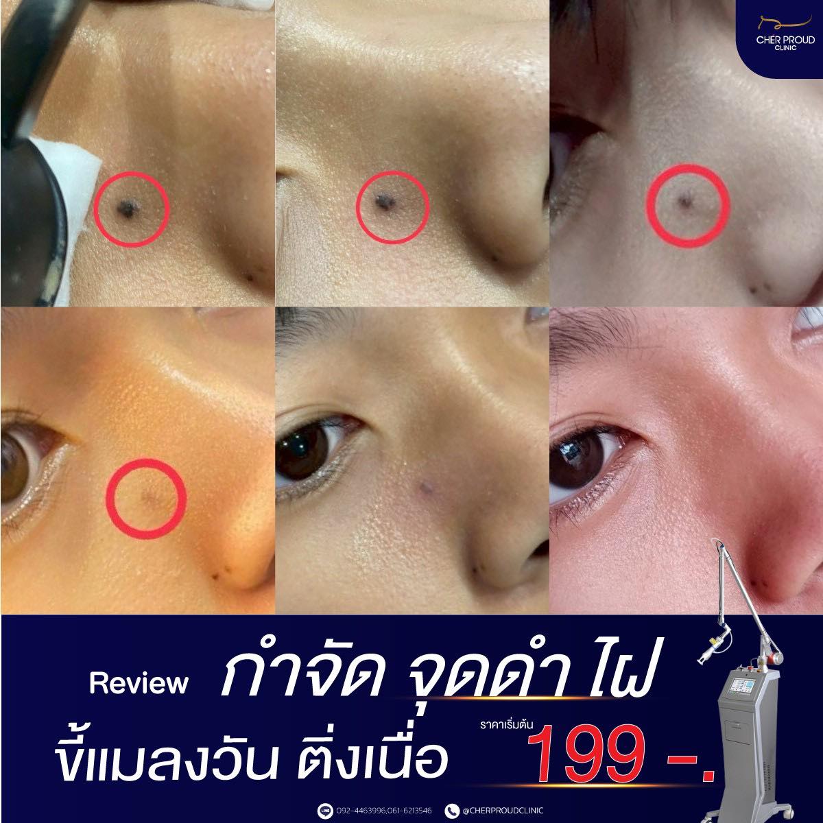 Cher proud clinic ศัลยกรรมคลินิกความงาม เชียงใหม่ เชียงราย Facebook ad