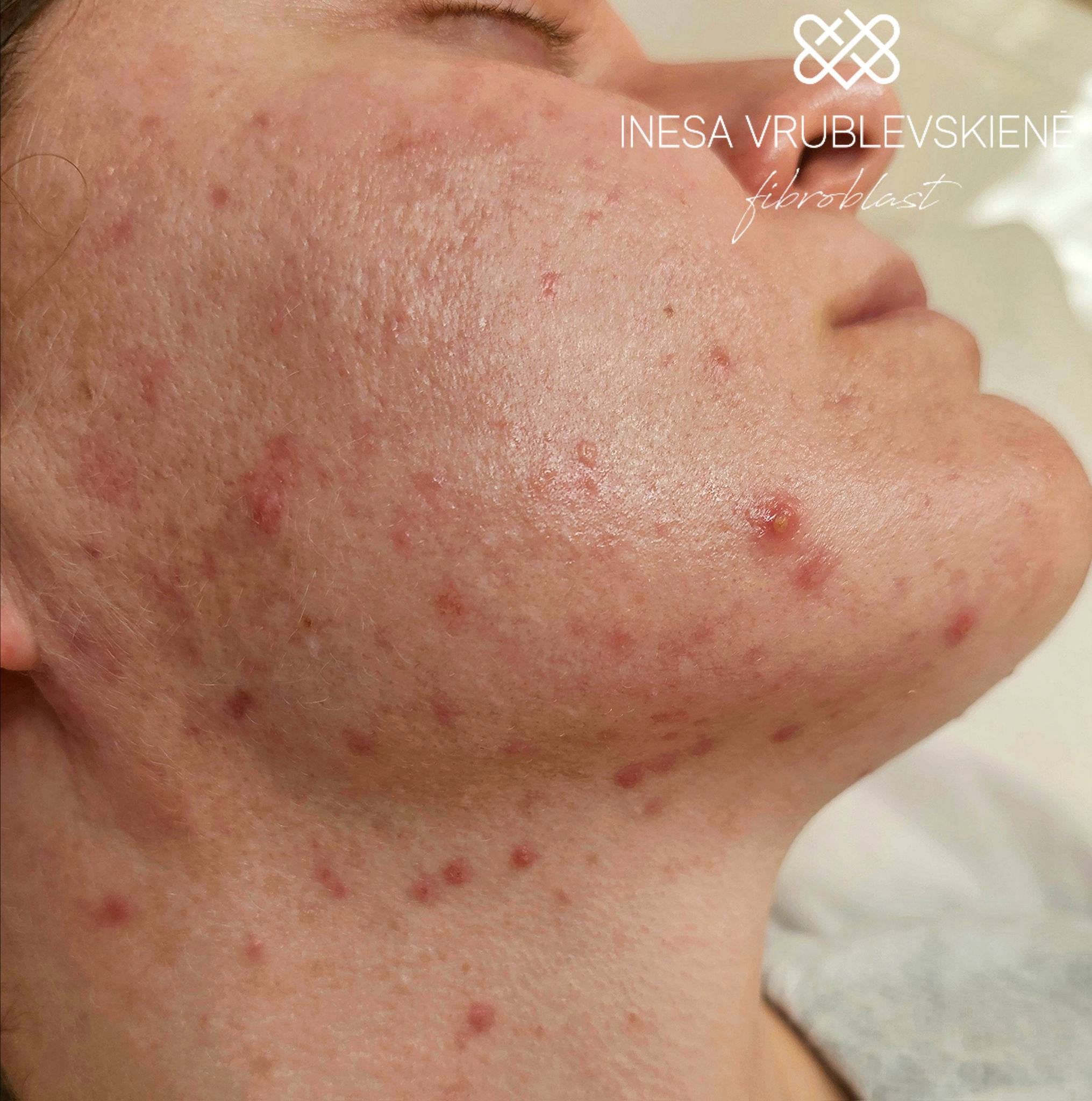 Inesa Vrublevskienė Fibroblast - Odos estetikė Facebook ad: RIEBI / MIŠRI ODA, tai ne tik blizgesys.