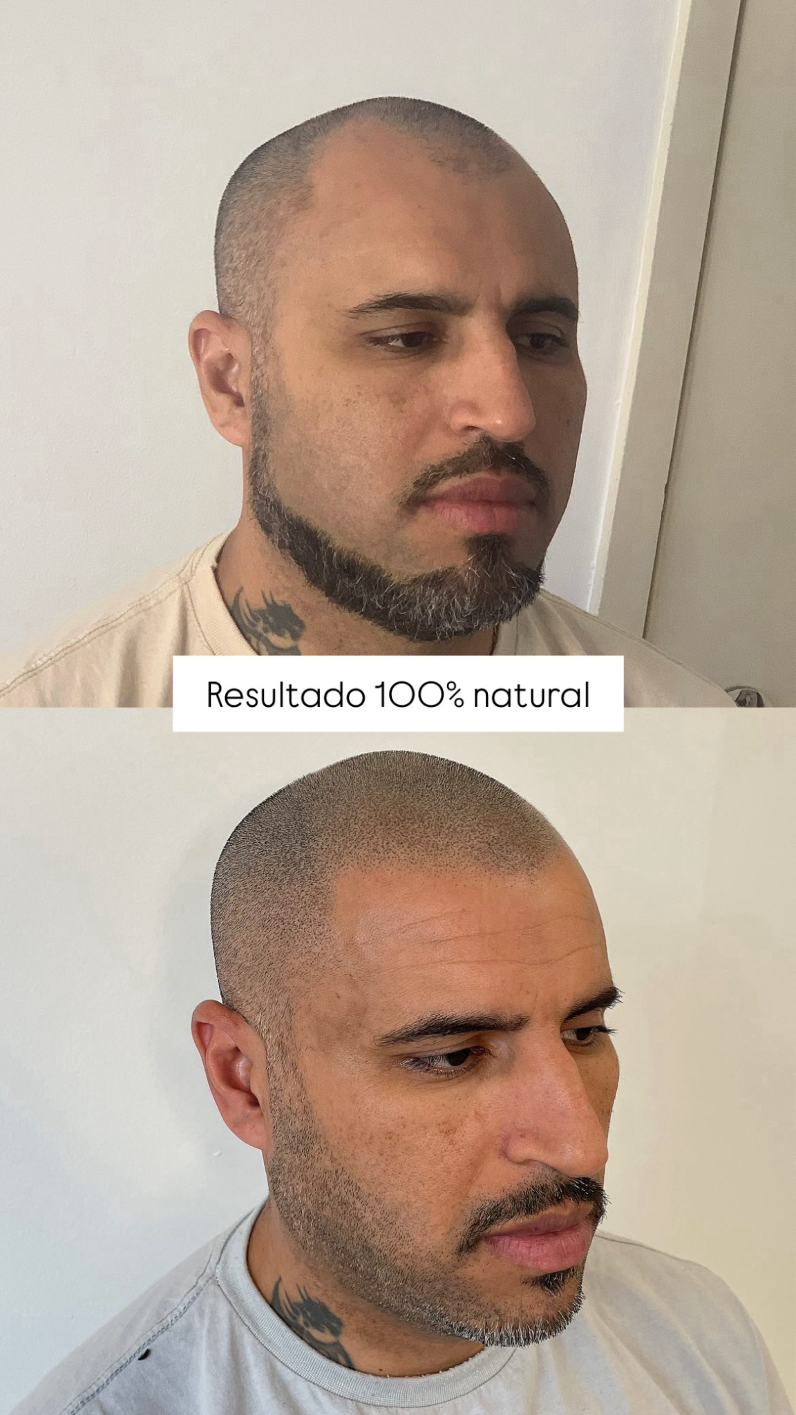 Henrique Paim micro capilar Facebook ad: Recupere o visual de cabelo raspado