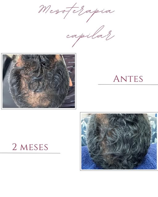 Vandan Hair & Skin Facebook ad: Mesoterapia Capilar Con Dutasterida