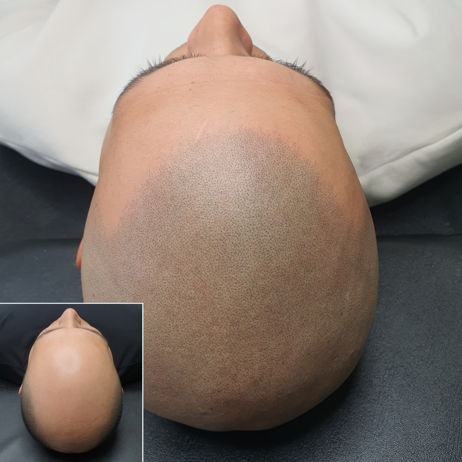 Skalp Facebook ad: Scalp Micropigmentation (Hair Loss Tattoo) is a simple…