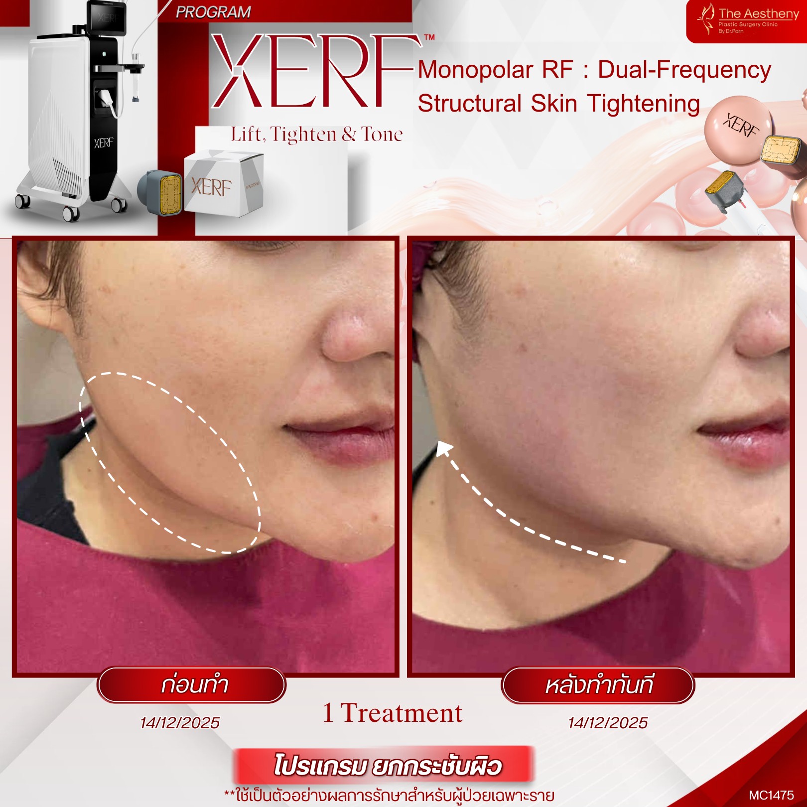 คลินิกหมอป่านสุราษฎร์ธานี/The Aestheny Clinic by Dr. Parn-ดิเอสเธนี คลินิก Facebook ad: เหนียงหาย หน้าเรียวเป๊ะ ยกกระชับถึงชั้นลึก…