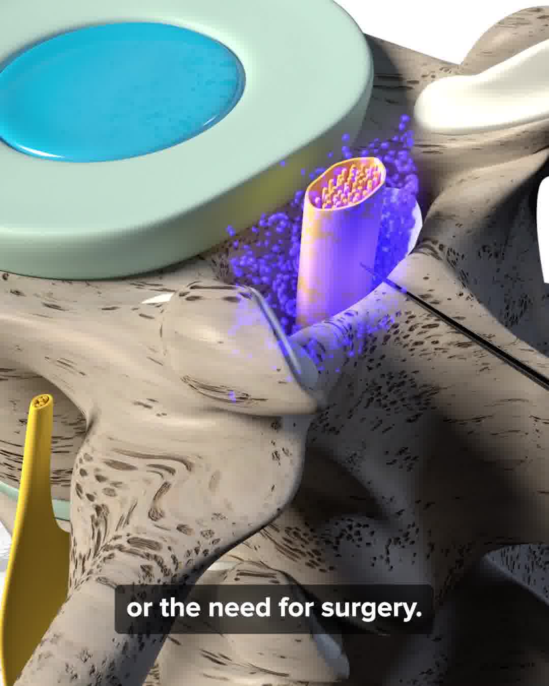 NeuroMD Facebook ad: Eliminate Back Pain By.