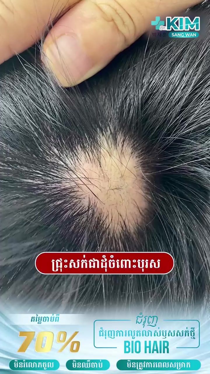 មជ្ឈមណ្ឌលកែសម្ផស្ស គីម សាំង វ័ន្ត Facebook ad: ការព្រមាន៖ សក់ជ្រុះច្រើន អាចនាំទៅរកការហូយជាអចិន្ត្រៃយ៍!