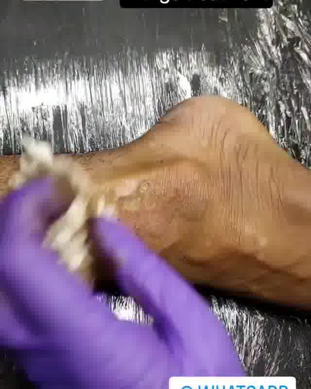microvitiligo Facebook ad: Contact Us