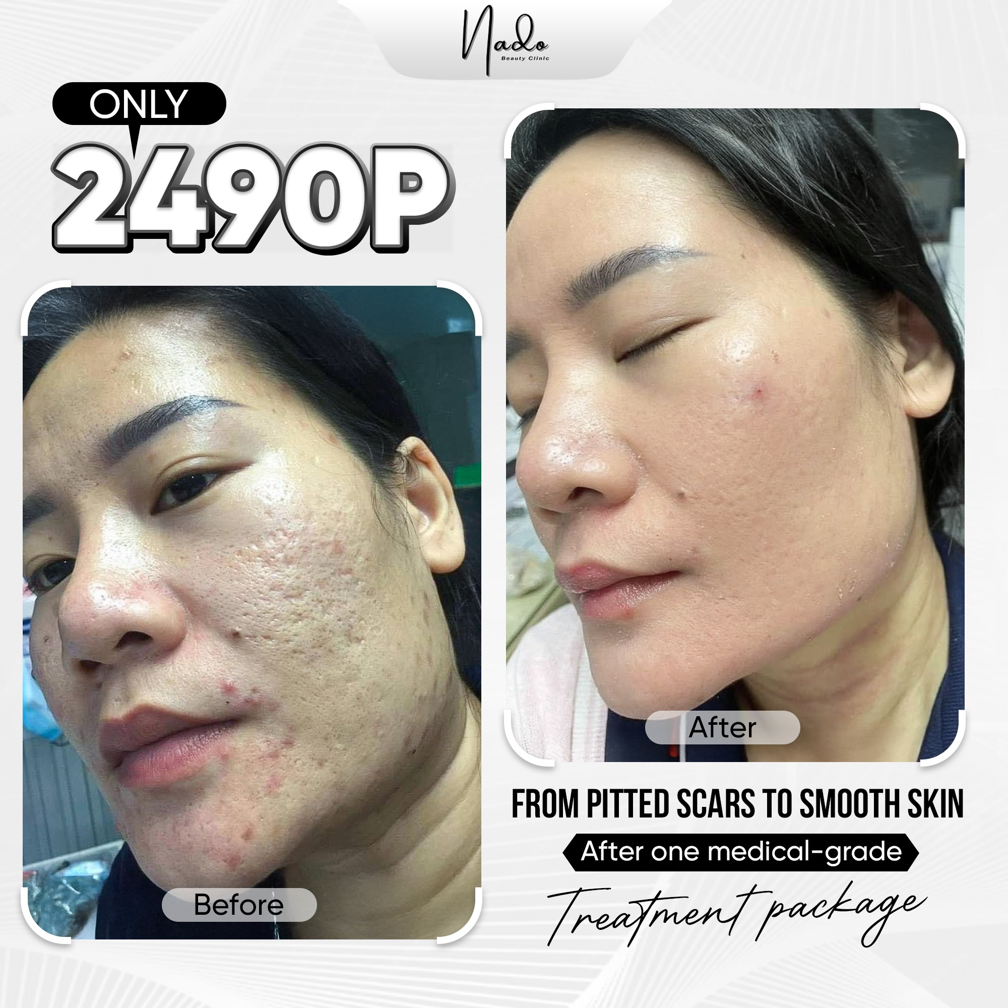 Nado Clinic Facebook ad: PITTED ACNE SCARS, THEY WON’T HEAL ON THEIR…