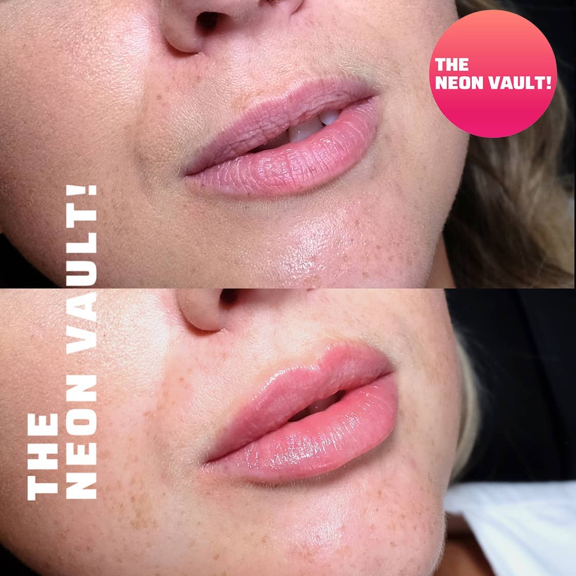 The Neon Vault Facebook ad: First time Lip Fillers for this beauty