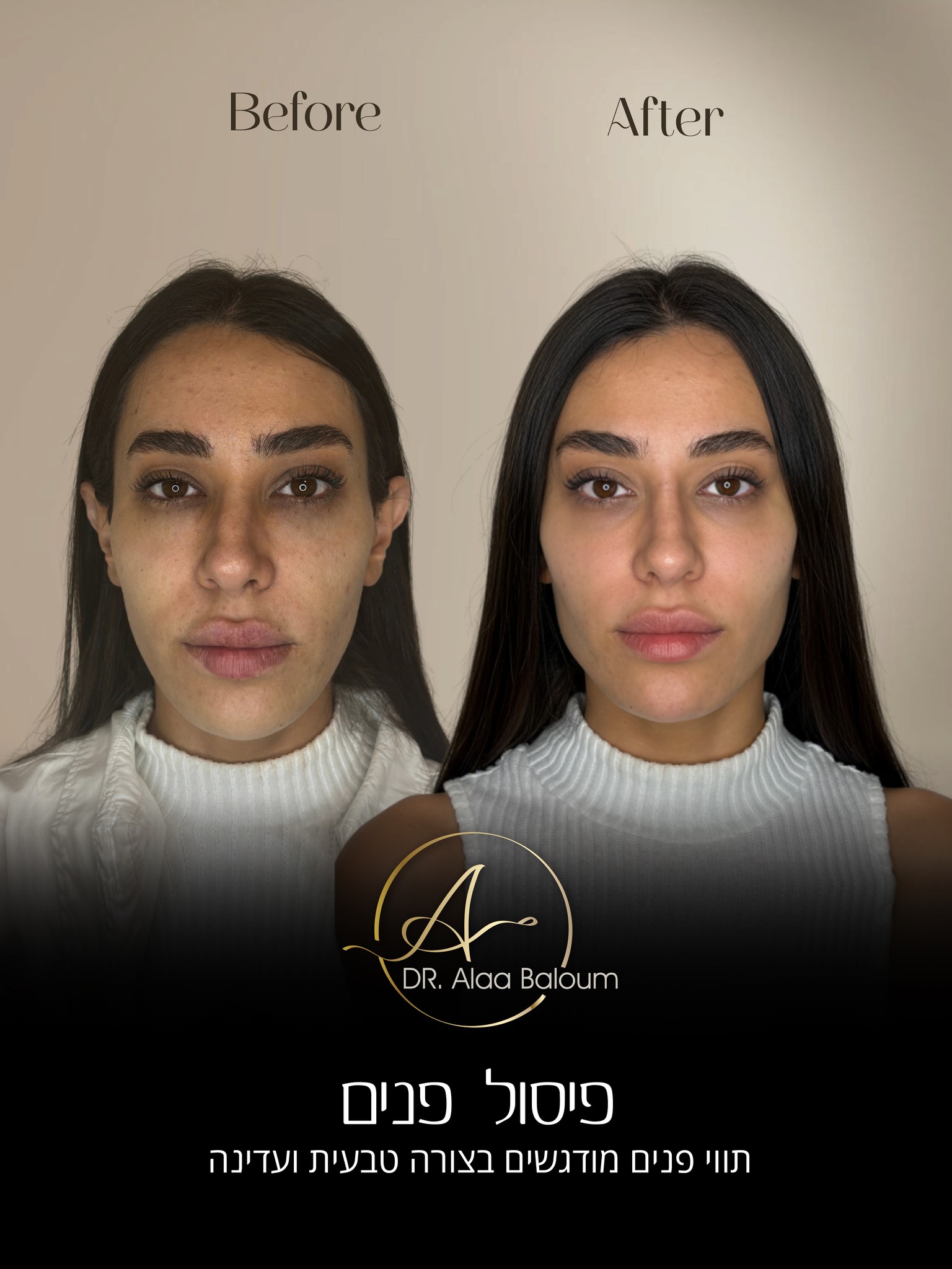 Dr-A’laa Baloum Facebook ad: למראה פנים טבעי ויפה