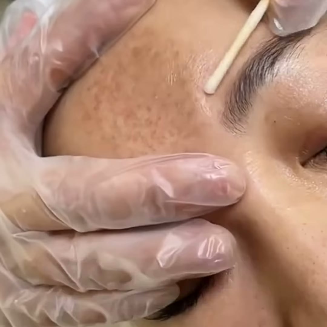 Miami MD Facebook ad: Cómo Detener las Manchas Oscuras Desde su Origen