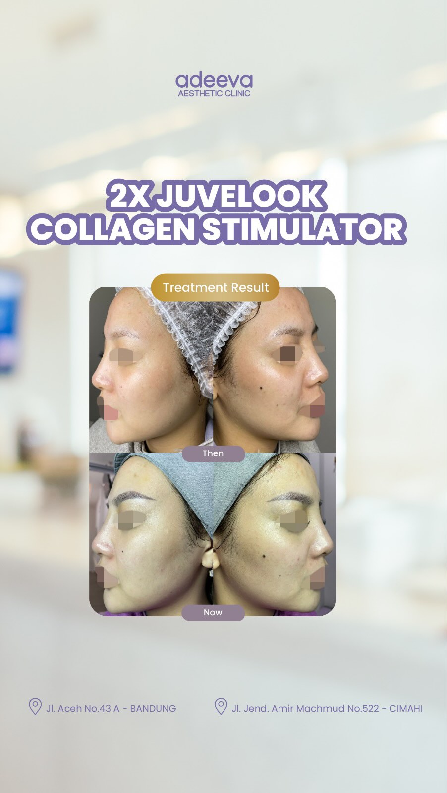 Adeeva Aesthetic Clinic Facebook ad: Treatment Result of Juvelook Revolutionary Collagen…