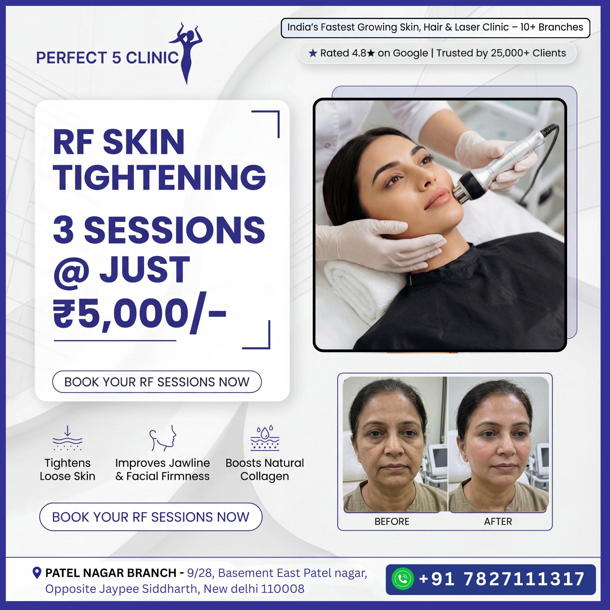 Perfect 5 Clinic - Patel Nagar Facebook ad: 3 RF Skin Treatment sessions at just ₹5,000, Non-surgical…