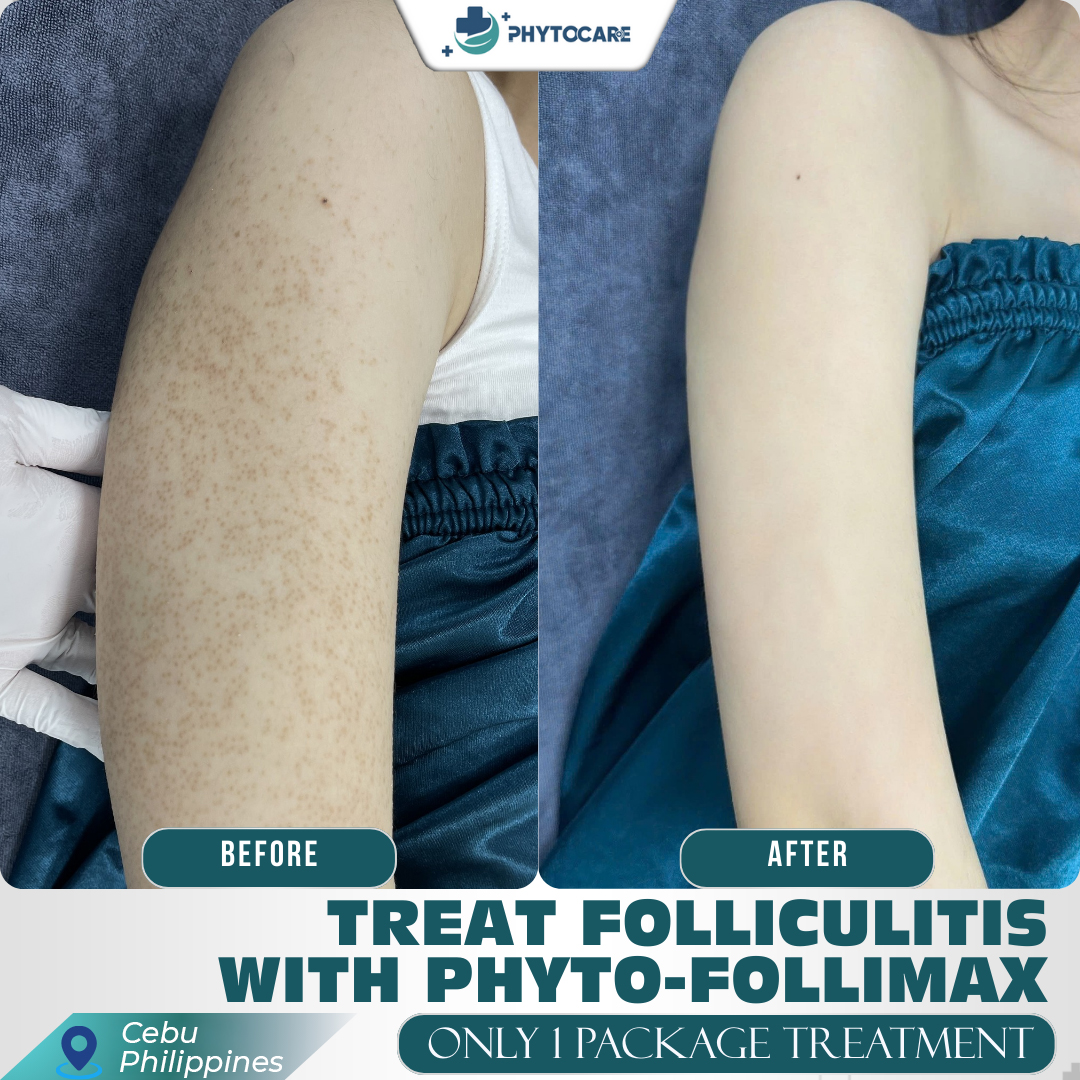 Cebu Skin & Dermatology Clinic Facebook ad: THE SAME ARM, WHY DOES THE SKIN LOOK…