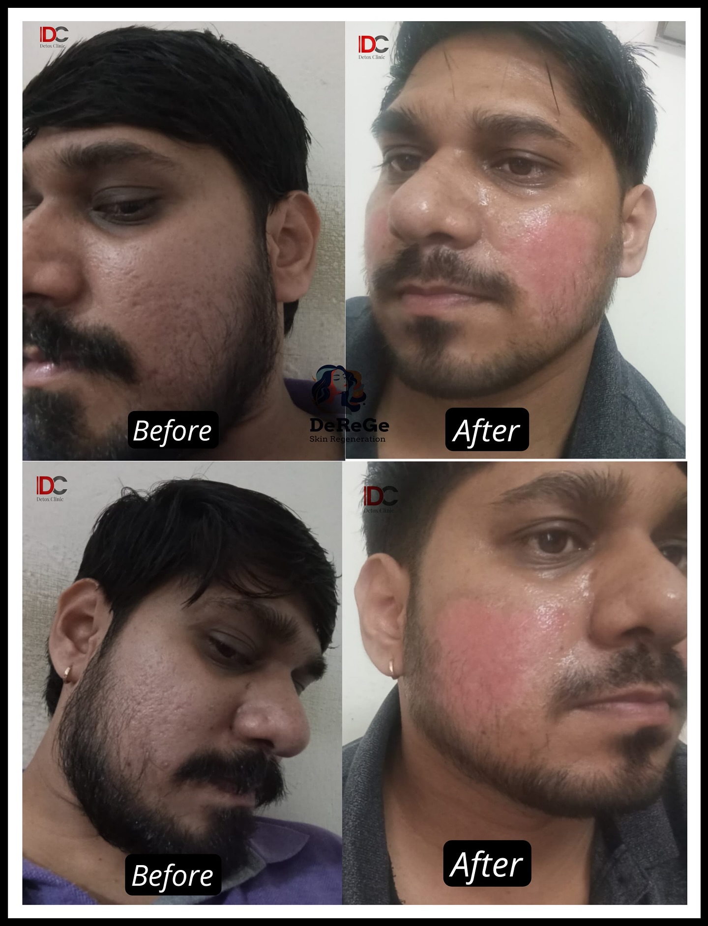 Detox Clinic Facebook ad: Successful Results Of Acne Scars By DeGeRe Treatment