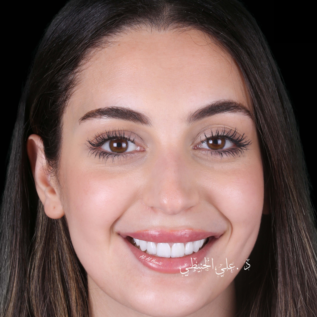 Dr Ali Omair Al-Heneiti - علي الحنيطي Facebook ad: قشور خزفية بمظهر ولون طبيعي | Natural laminate veneers