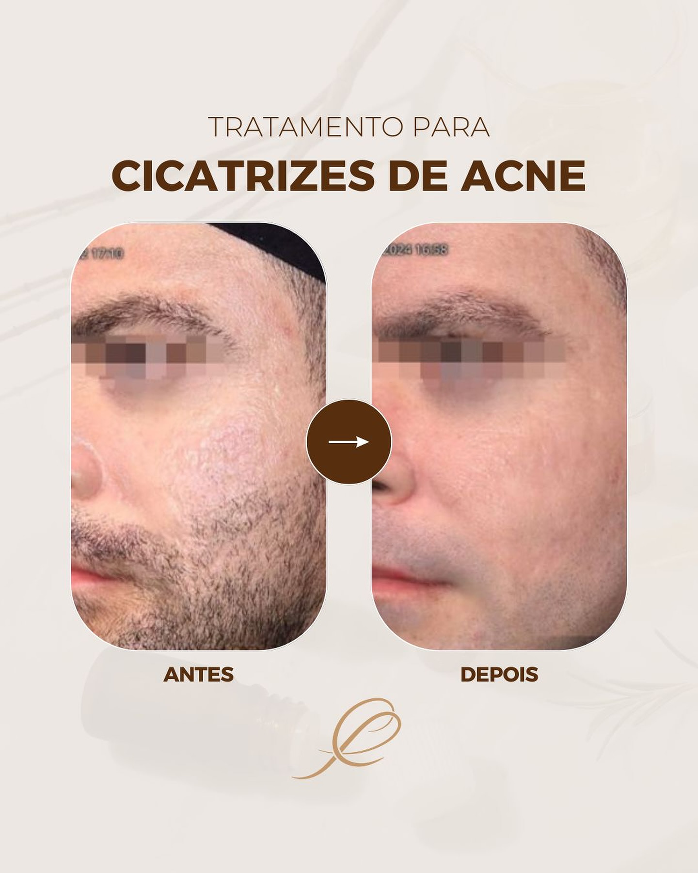 Dra Paula Cordeiro Facebook ad: Resultado incrível deste paciente com cicatrizes de acne!