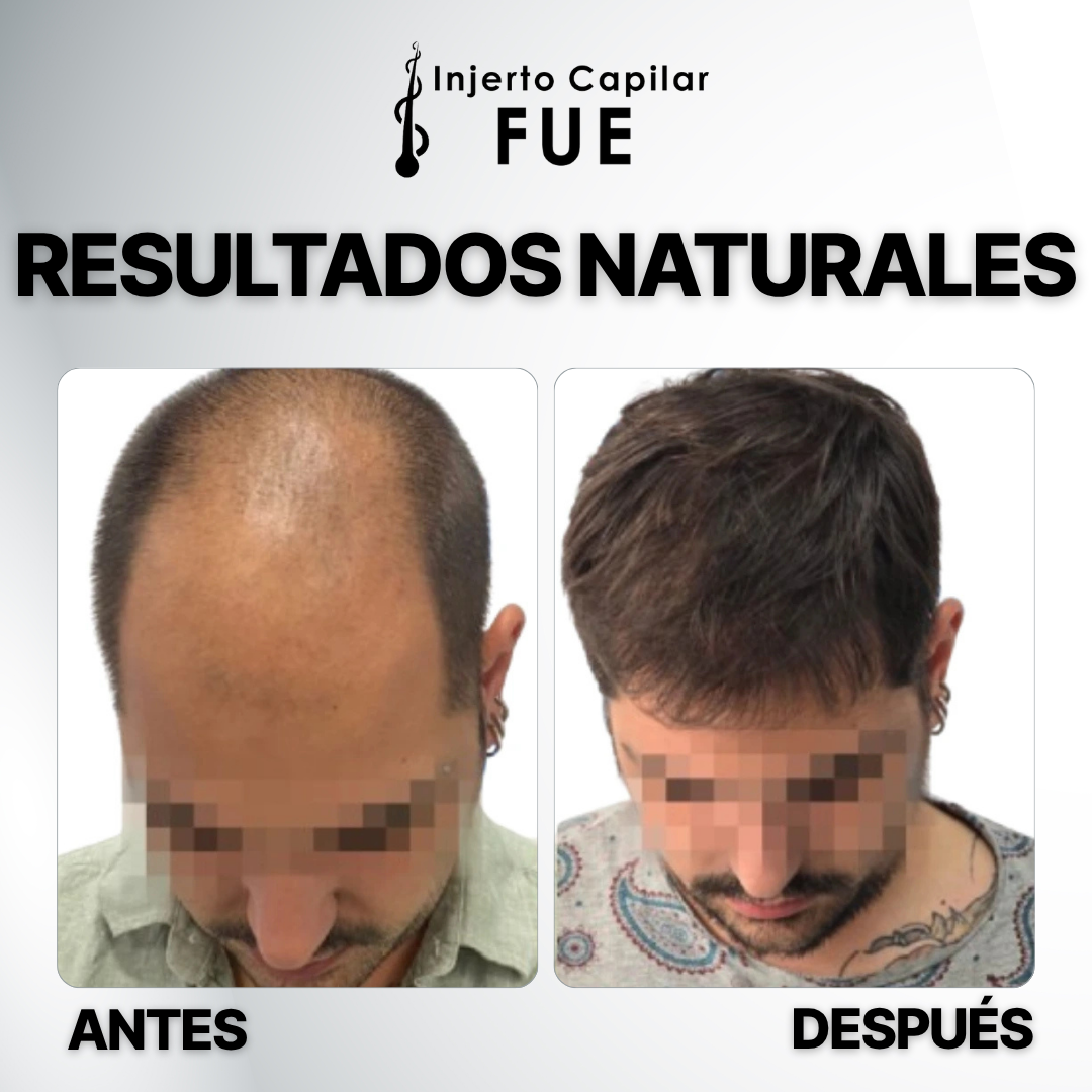 Clínicas Injerto Capilar FUE Facebook ad