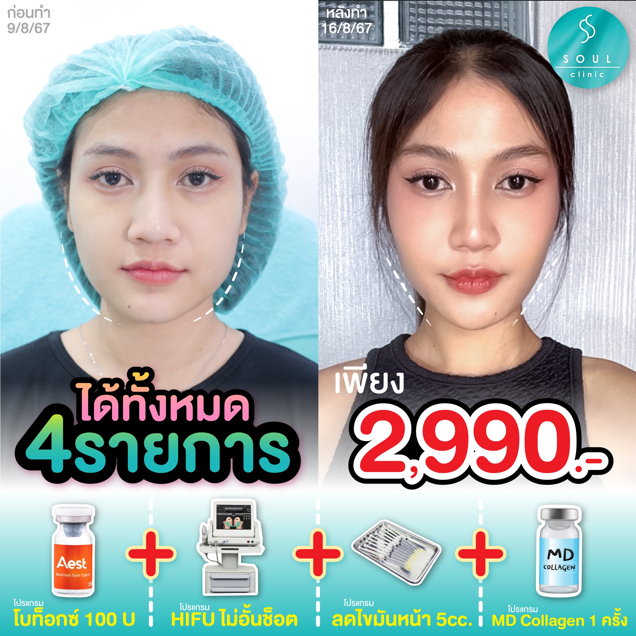 Soul clinic - โซลว์ คลินิก ห้วยขวาง Facebook ad: โปรแกรมโบท็อกซ์หน้าเรียว ✚ ริ้วรอย 100 ยูนิต!