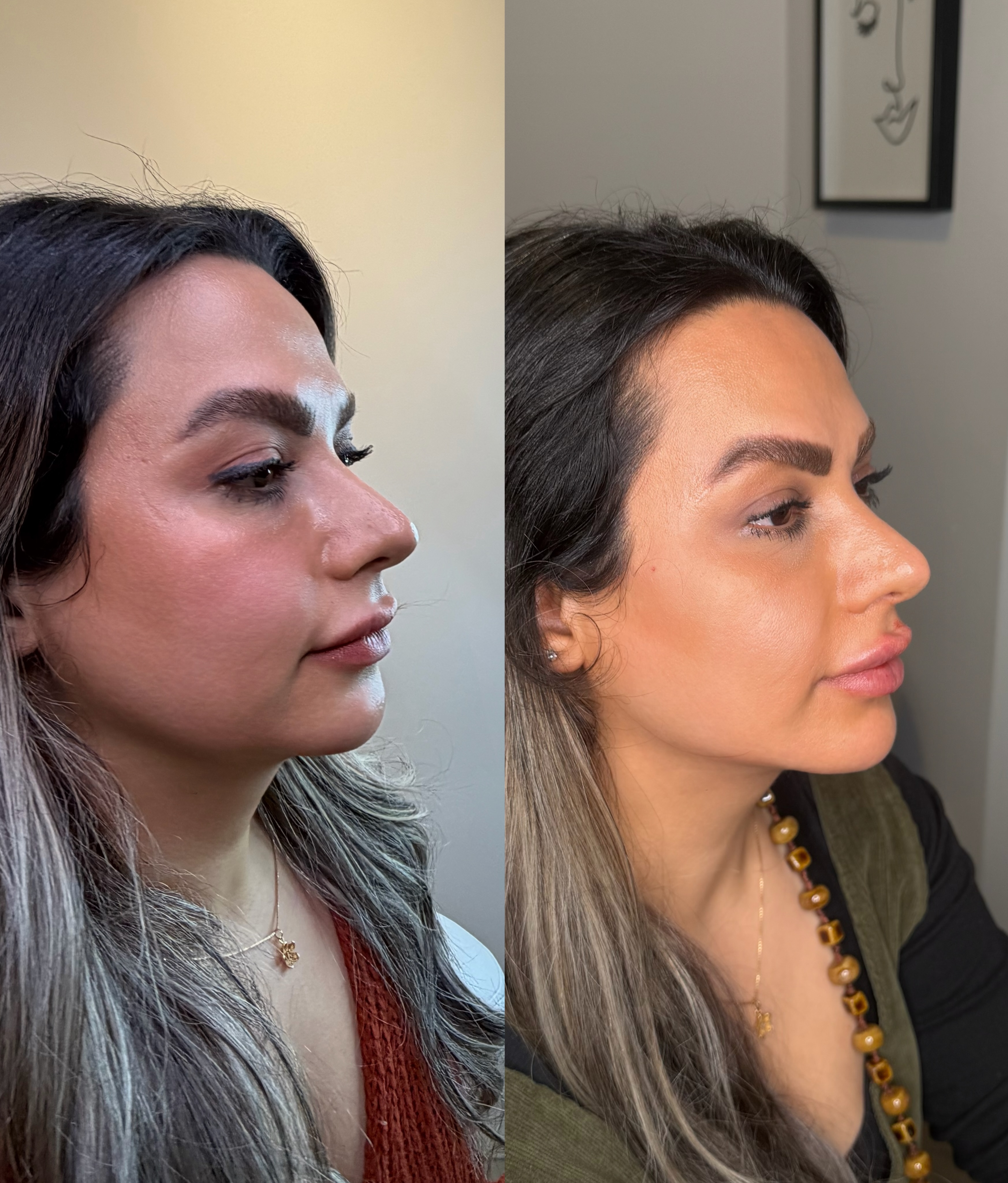 Aesthetic Nurse Marta Facebook ad: 8 ML Full Face using @revanesse dermal fillers.