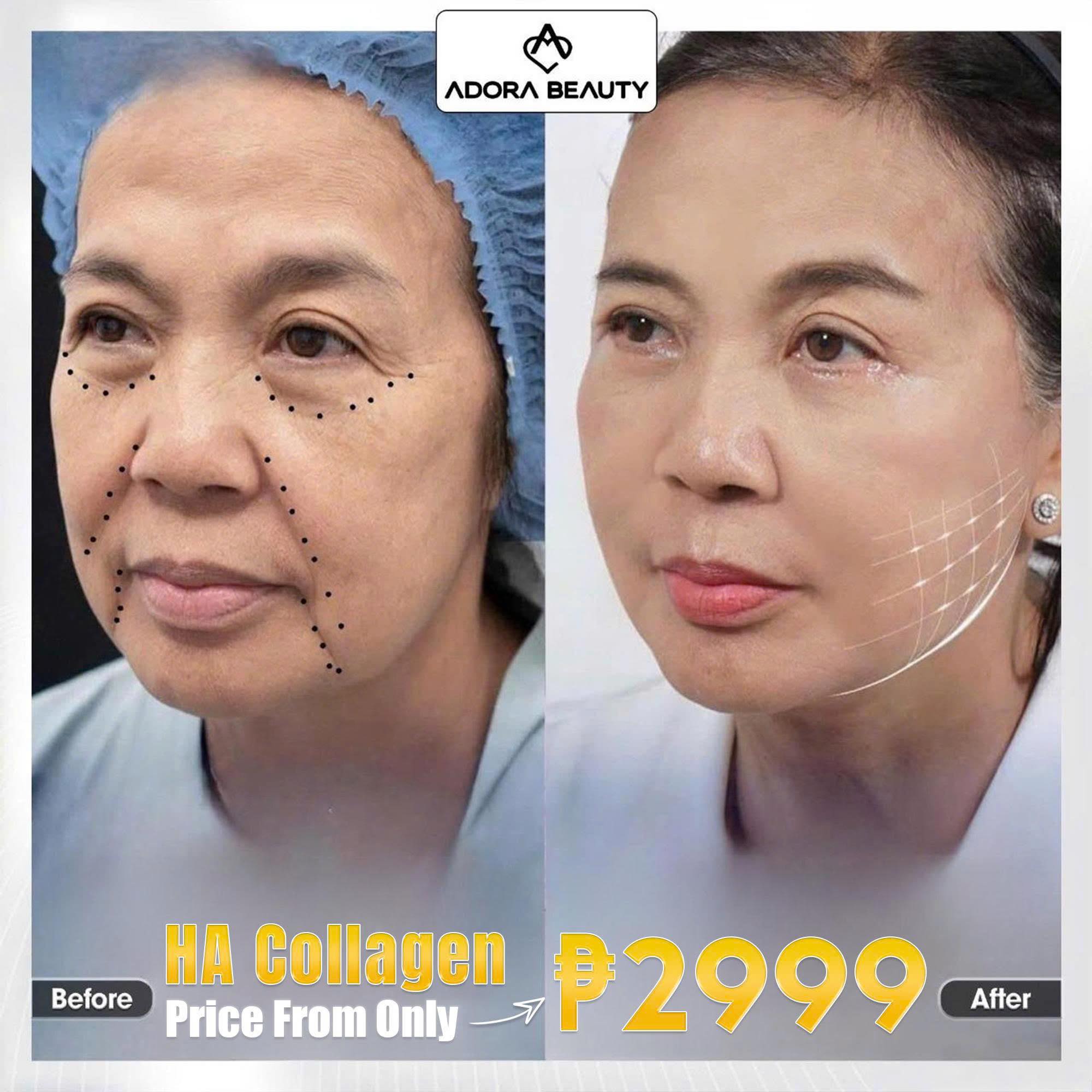Adora Beauty Clinic in Manila Facebook ad