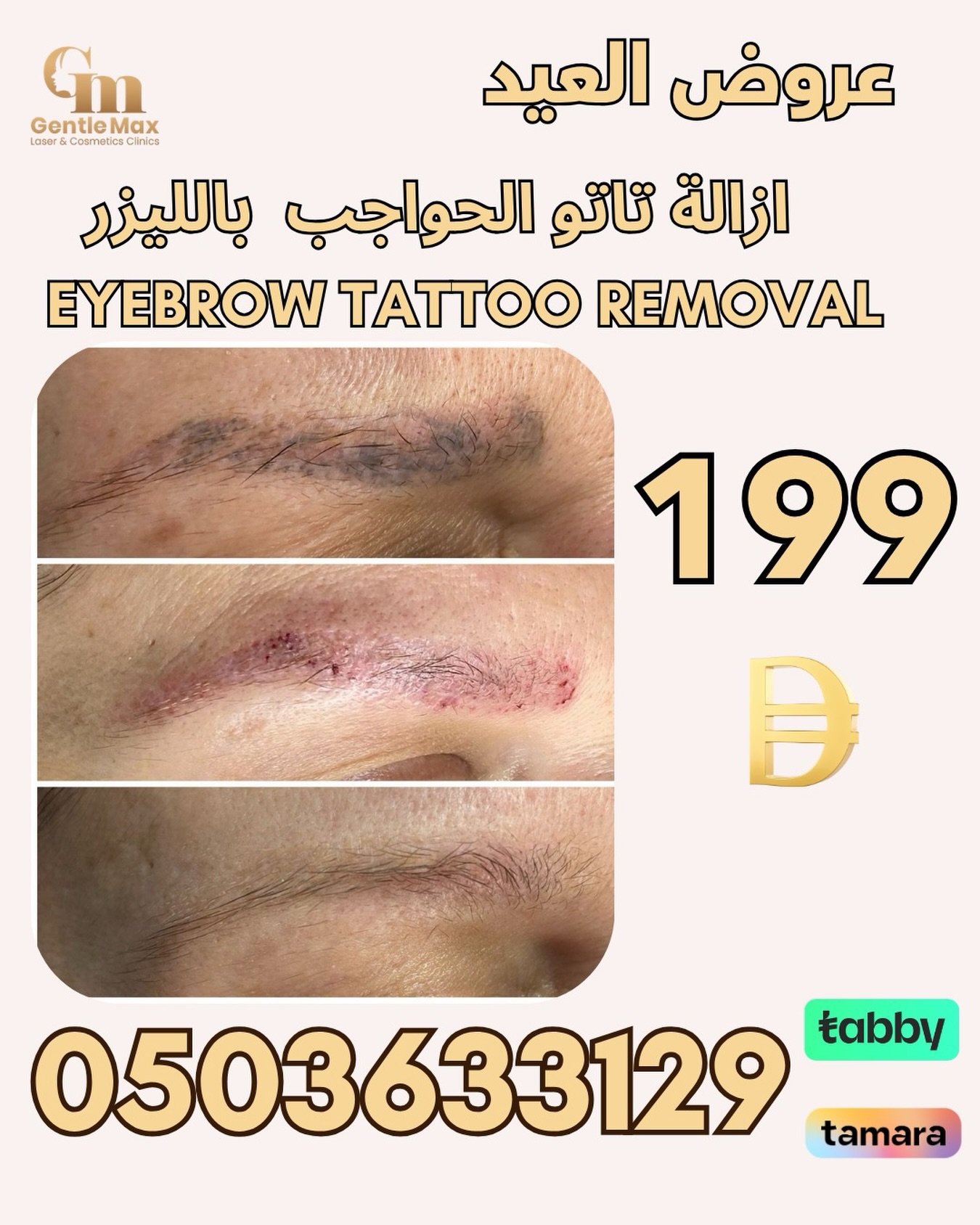 Gentle Max Clinics Facebook ad: إزالة تاتو الحواجب بالليزر