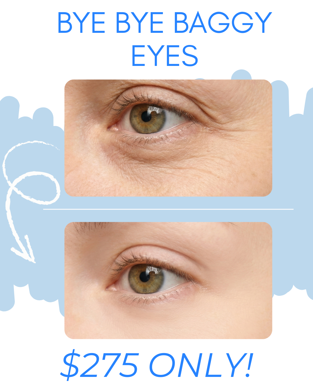 Elite Spa Massachusetts Facebook ad: Bye Bye Baggy Eyes for Only $275!