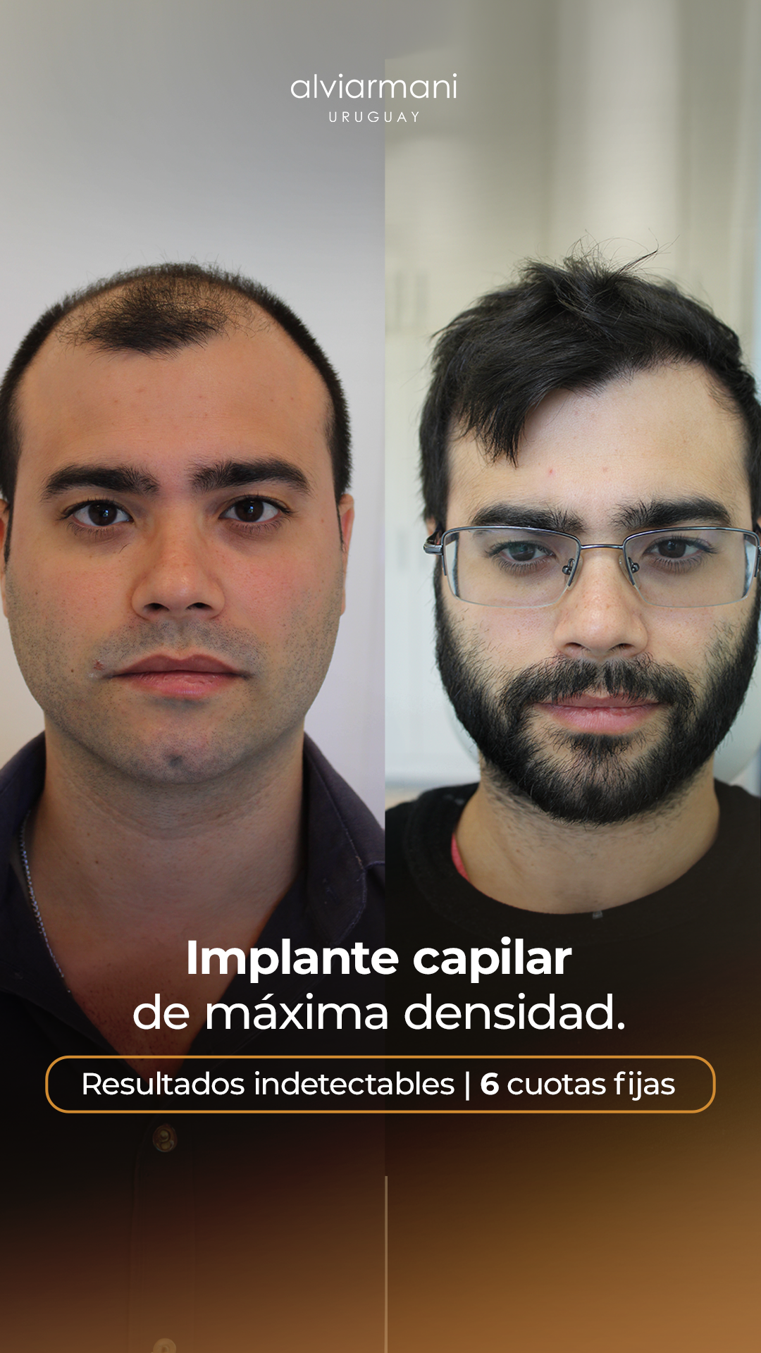 Alvi Armani Uruguay Facebook ad: Tu implante en 6 cuotas