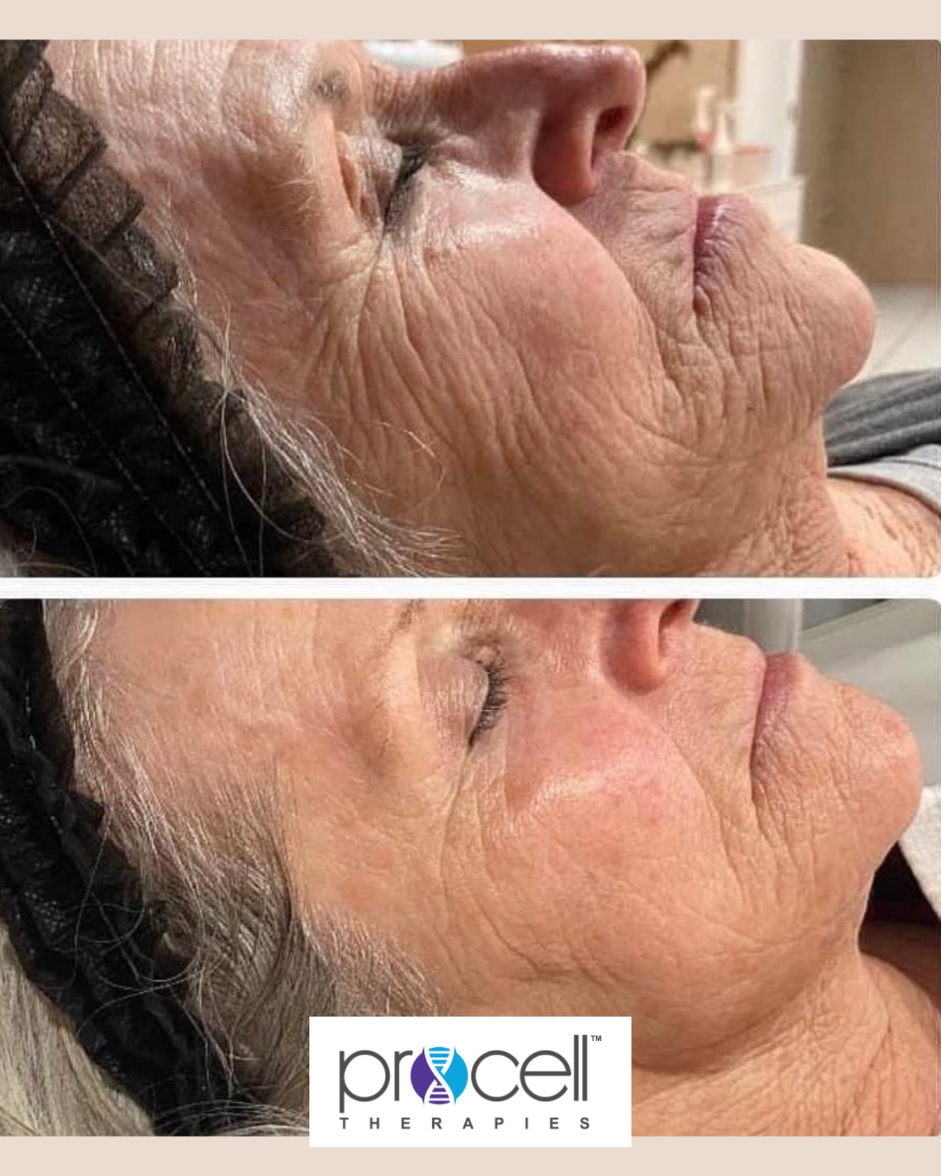 Jab Lab Melbourne Facebook ad: More incredible results courtesy of @procelltherapiesanz