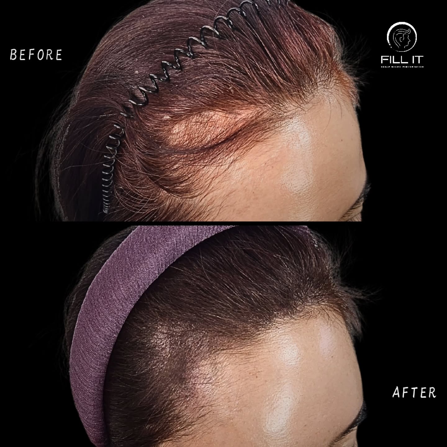 FILL IT_smp Facebook ad: An M-shaped receding hairline at the front can…