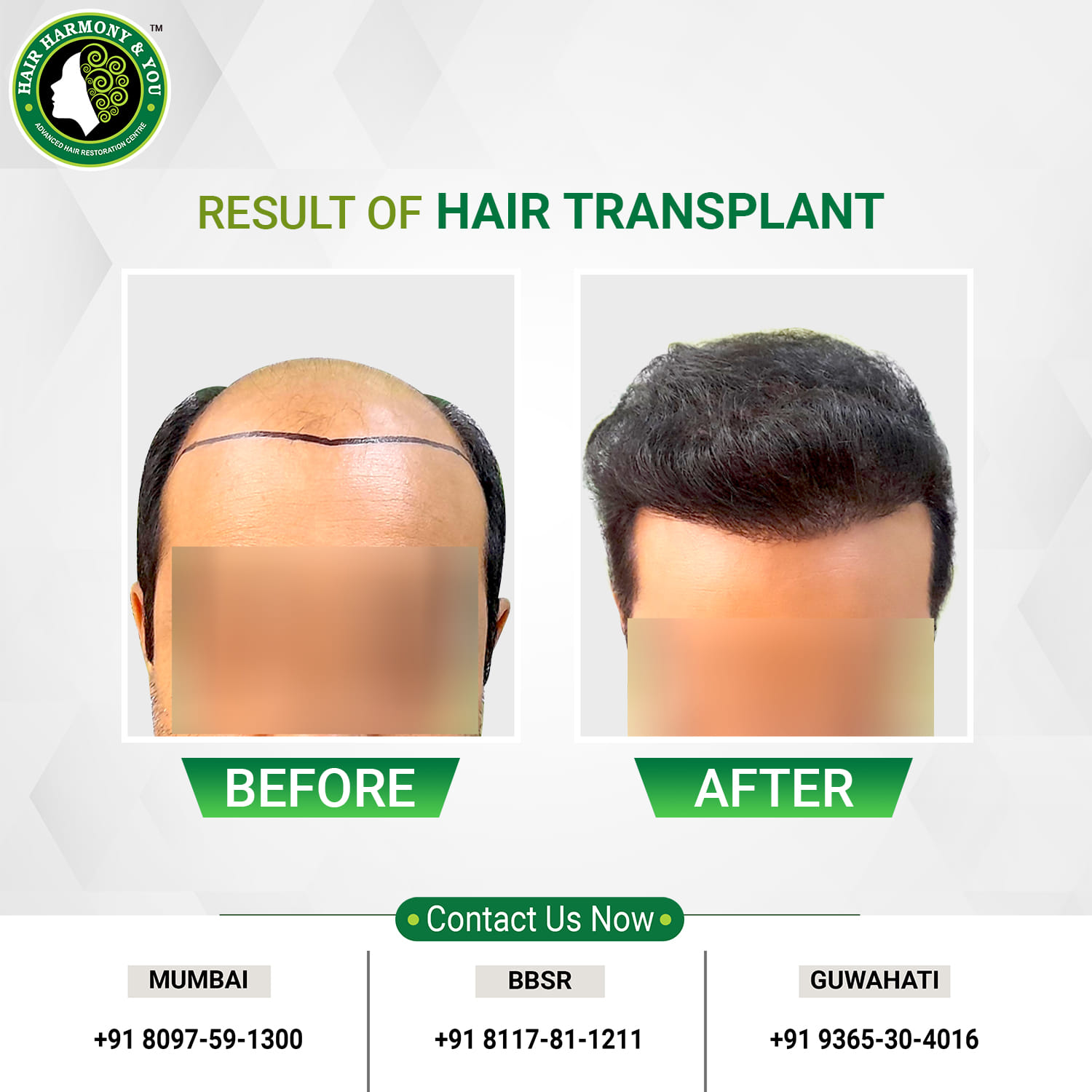 HHY GUWAHATI Facebook ad: Think About Your Hair Loss.