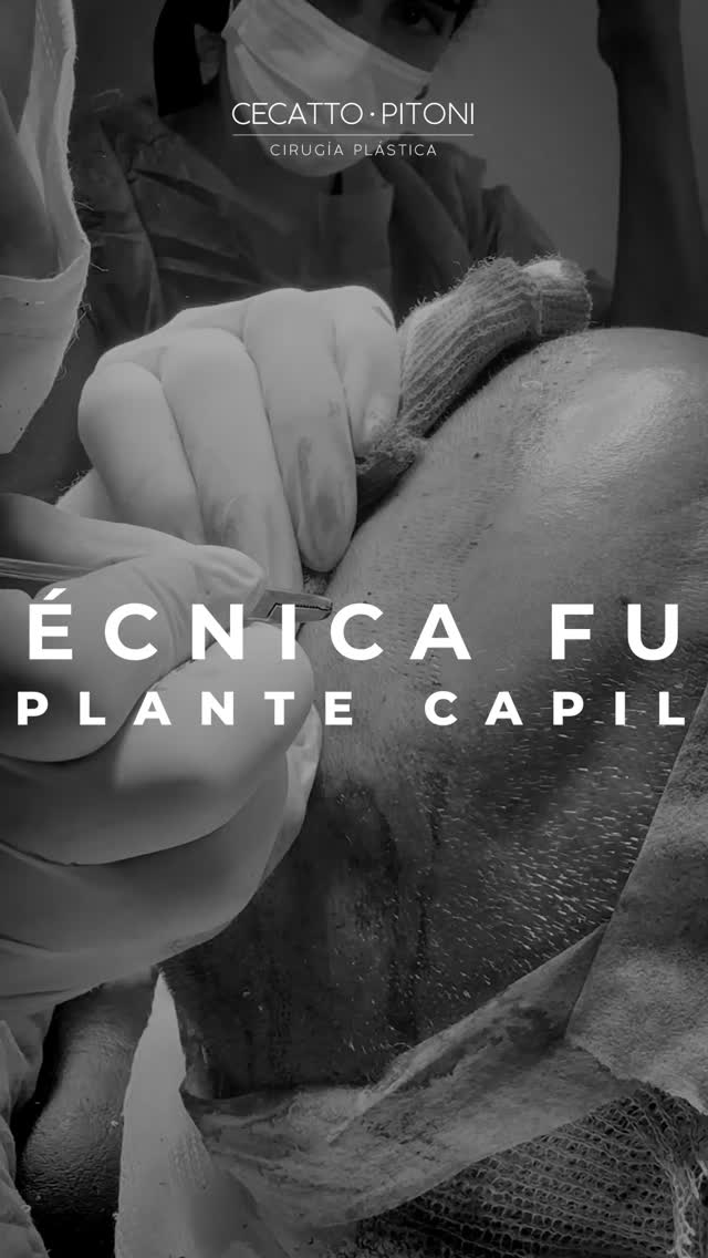 Cecatto Pitoni Cirugía Estética Facebook ad: Implante Capilar con Técnica FUE Zafiro