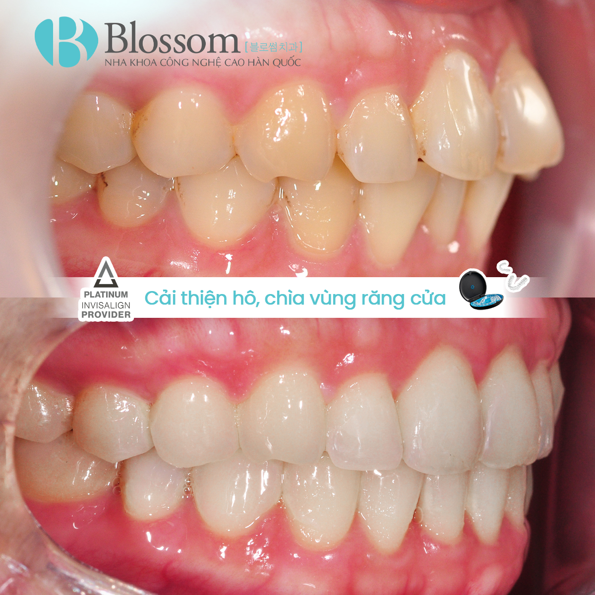Blossom Dental Clinic - Nha Khoa Công Nghệ Cao Hàn Quốc Facebook ad