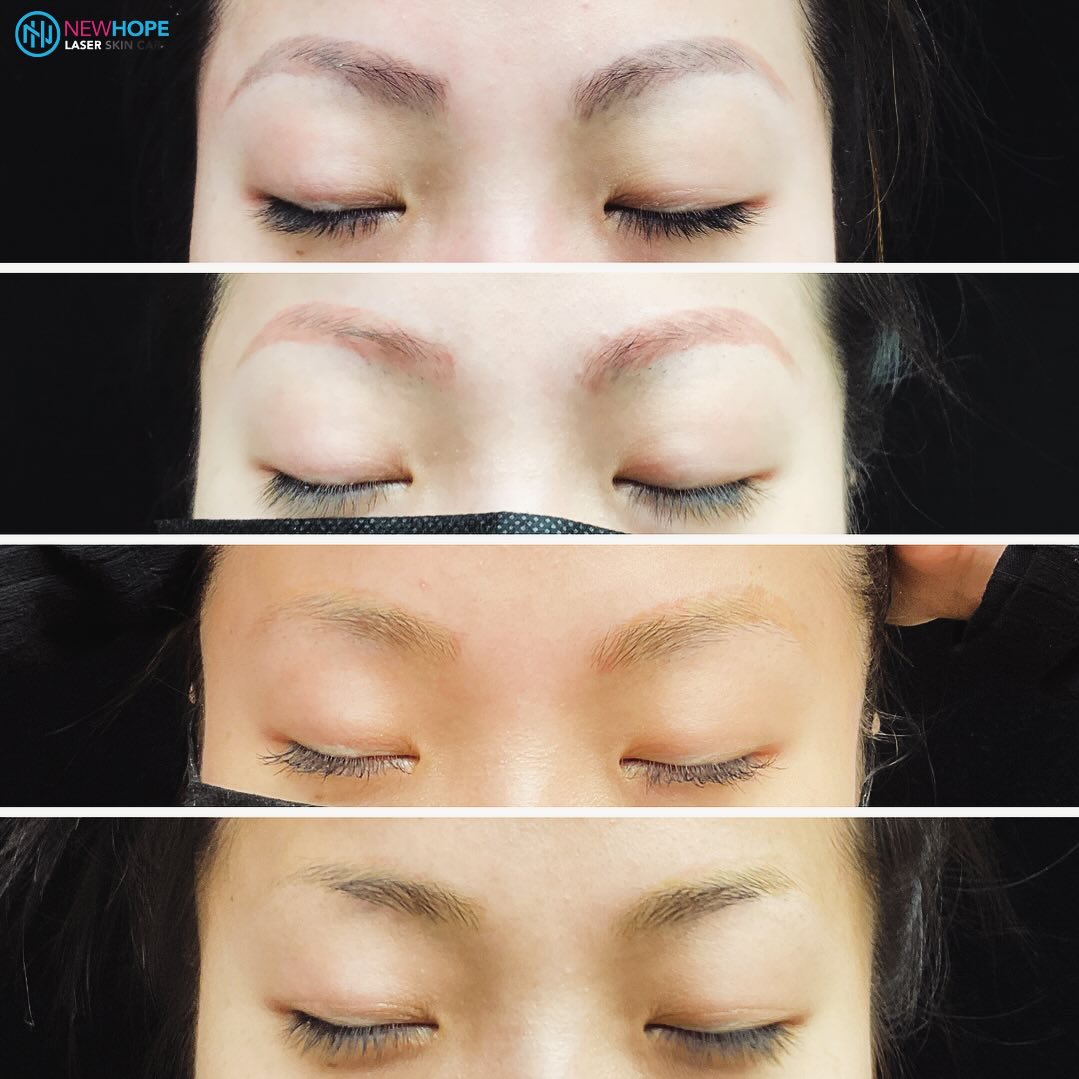 Newhope Laser Skin Care: Phuong Tien, MD Facebook ad: Newhope Laser Skin Care | laser tattoo removal | 14120…