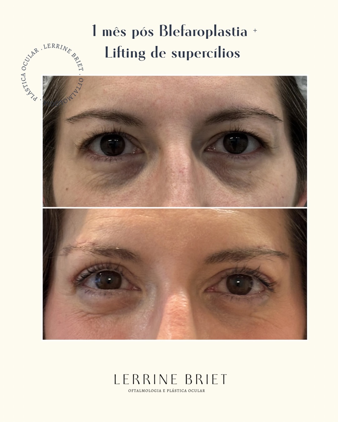 Lerrine Briet Facebook ad: 1 mês de pós-operatório de Blefaroplastia superior +…